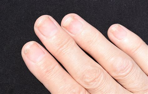 ongle sans décollement.